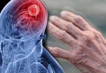 Паркинсонизм: понятие, признаки, лечение