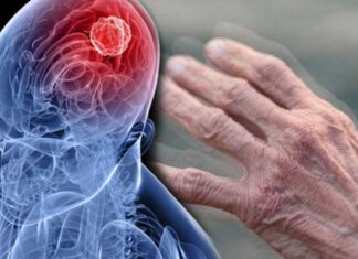 Паркинсонизм: понятие, признаки, лечение