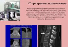 Диагностика заболеваний поясничного отдела позвоночника при помощи компьютерной томографии (КТ) в Украине