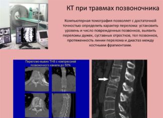 Диагностика заболеваний поясничного отдела позвоночника при помощи компьютерной томографии (КТ) в Украине