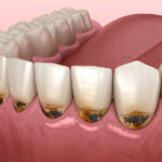 Причины появления кариеса