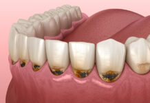 Причины появления кариеса