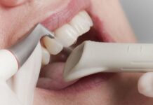 Зубной камень: причины образования, последствия и методы профилактики