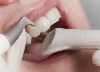 Зубной камень: причины образования, последствия и методы профилактики