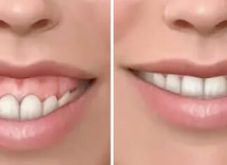 Особенности десневой улыбки: Природа, эстетика и серьезные