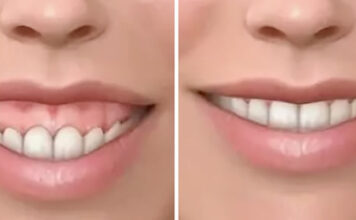 Особенности десневой улыбки: Природа, эстетика и серьезные