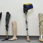 Преимущества и особенности протезирования конечностей: Возвращение к активной жизни