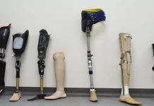 Преимущества и особенности протезирования конечностей: Возвращение к активной жизни