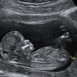 УЗИ в первом триместре беременности