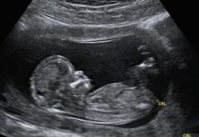 УЗИ в первом триместре беременности