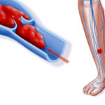 Тромбоз — что за заболевание, его причины