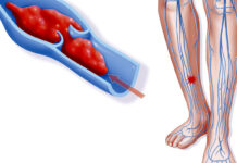 Тромбоз — что за заболевание, его причины