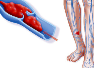 Тромбоз — что за заболевание, его причины