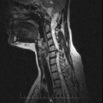 Важность МРТ шейного отдела позвоночника: диагностика, предотвращение и лечение