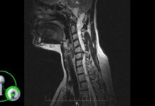 Важность МРТ шейного отдела позвоночника: диагностика, предотвращение и лечение