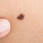 Удаление родинок — методы, и для чего проводится процедура