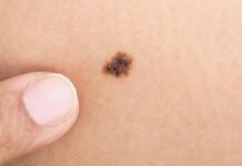 Удаление родинок — методы, и для чего проводится процедура