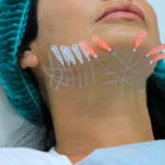 Нитевой лифтинг лица: Почему стоит выбрать эту процедуру для омоложения