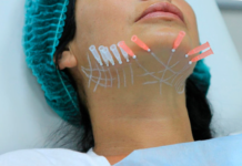 Нитевой лифтинг лица: Почему стоит выбрать эту процедуру для омоложения