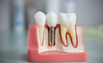 Почему стоит протезировать зубы: Возвращение к улыбке и качественная жизнь