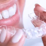 Красивая улыбка с элайнерами: Революционный подход к ортодонтическому лечению