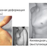 Какую болезнь называют куриная грудь?