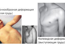 Какую болезнь называют куриная грудь?