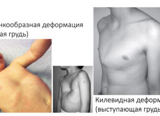 Какую болезнь называют куриная грудь?