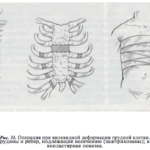 Какую болезнь называют куриная грудь?