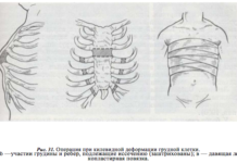 Какую болезнь называют куриная грудь?