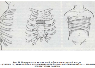 Какую болезнь называют куриная грудь?