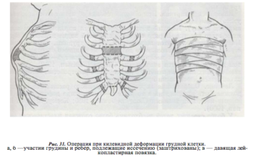 Какую болезнь называют куриная грудь?