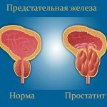Важность своевременного лечения простатита: забота о здоровье и предотвращение осложнений