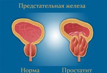 Важность своевременного лечения простатита: забота о здоровье и предотвращение осложнений