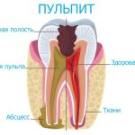 Лечение пульпита: основные методы и принципы