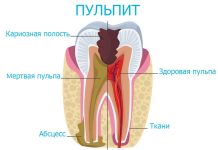 Лечение пульпита: основные методы и принципы