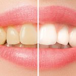 Переваги відбілювання зубів: яскрава посмішка та покращення самопочуття