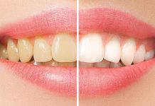 Переваги відбілювання зубів: яскрава посмішка та покращення самопочуття