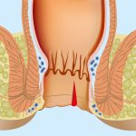Острая анальная трещина: Понимание, Симптомы и Лечение