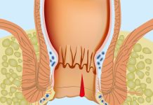Острая анальная трещина: Понимание, Симптомы и Лечение