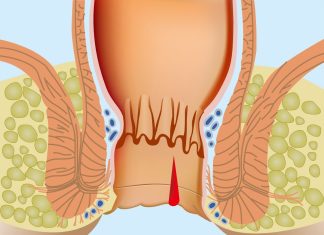 Острая анальная трещина: Понимание, Симптомы и Лечение