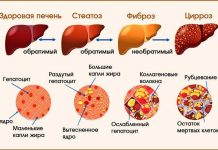 Лечение Цирроза Печени: Пути к Восстановлению Здоровья