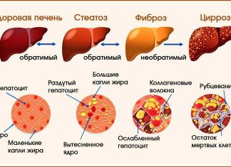 Лечение Цирроза Печени: Пути к Восстановлению Здоровья