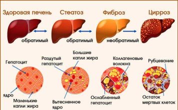 Лечение Цирроза Печени: Пути к Восстановлению Здоровья
