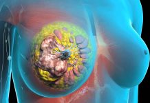 Рак молочной железы: как лечить и восстановить здоровье