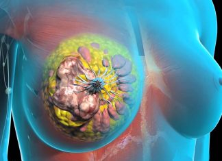 Рак молочной железы: как лечить и восстановить здоровье