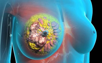 Рак молочной железы: как лечить и восстановить здоровье