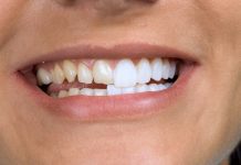 Идеальная Улыбка: Все, что Вам Нужно Знать о Винирах