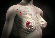 Гормональная терапия рака молочной железы