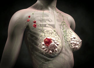 Гормональная терапия рака молочной железы